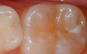 Sealant-Before - Pediatric Dentist & Orthodontics in Garland, TX